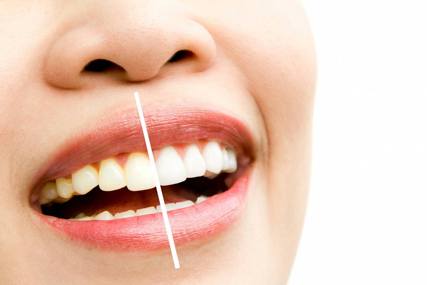 Dlaczego Warto Wykonywać Regularnie Skaling I Piaskowanie Zębów Zdrowy Styl Zyciapl 1111